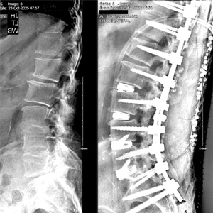 Spinal instrumentation to restore curvature