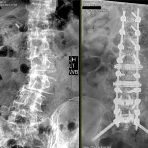 Correction of Scoliosis